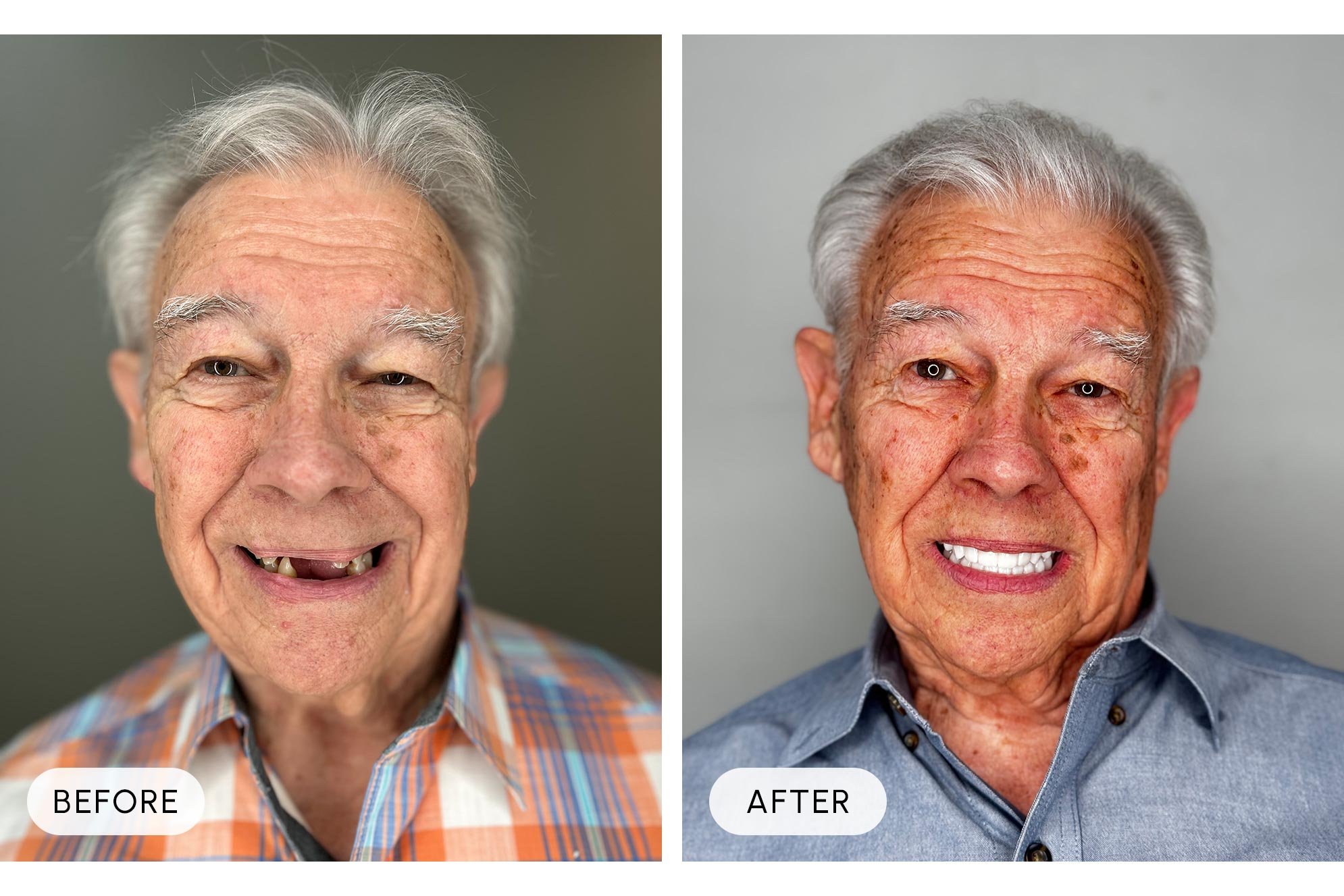 Side-by-side comparison of an elderly man before and after teeth whitening; on the left, the man is smiling with missing and discolored teeth, and on the right, he has a bright, full set of white teeth.