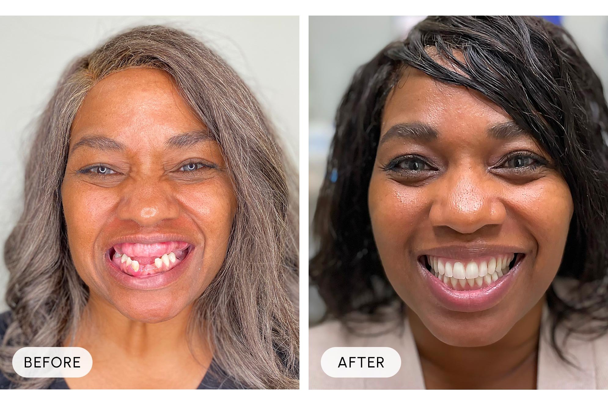 Side-by-side comparison of a woman before and after dental work. In the 'Before' image, she has missing and crooked teeth. In the 'After' image, she has a full, straight, and bright smile.