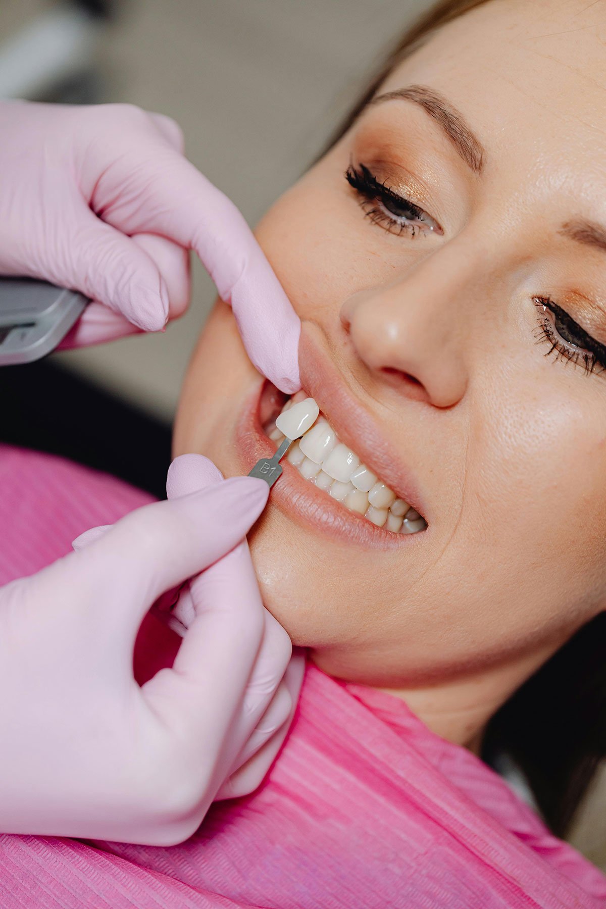 Close-up of a veneer being placed in a woman's mouth