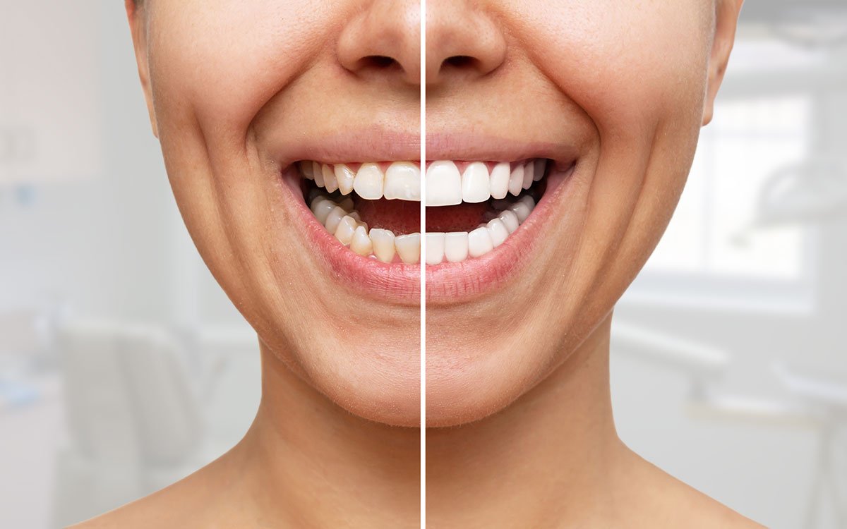 A person smiling; on the left side, the teeth look slightly more yellow than on the right side.