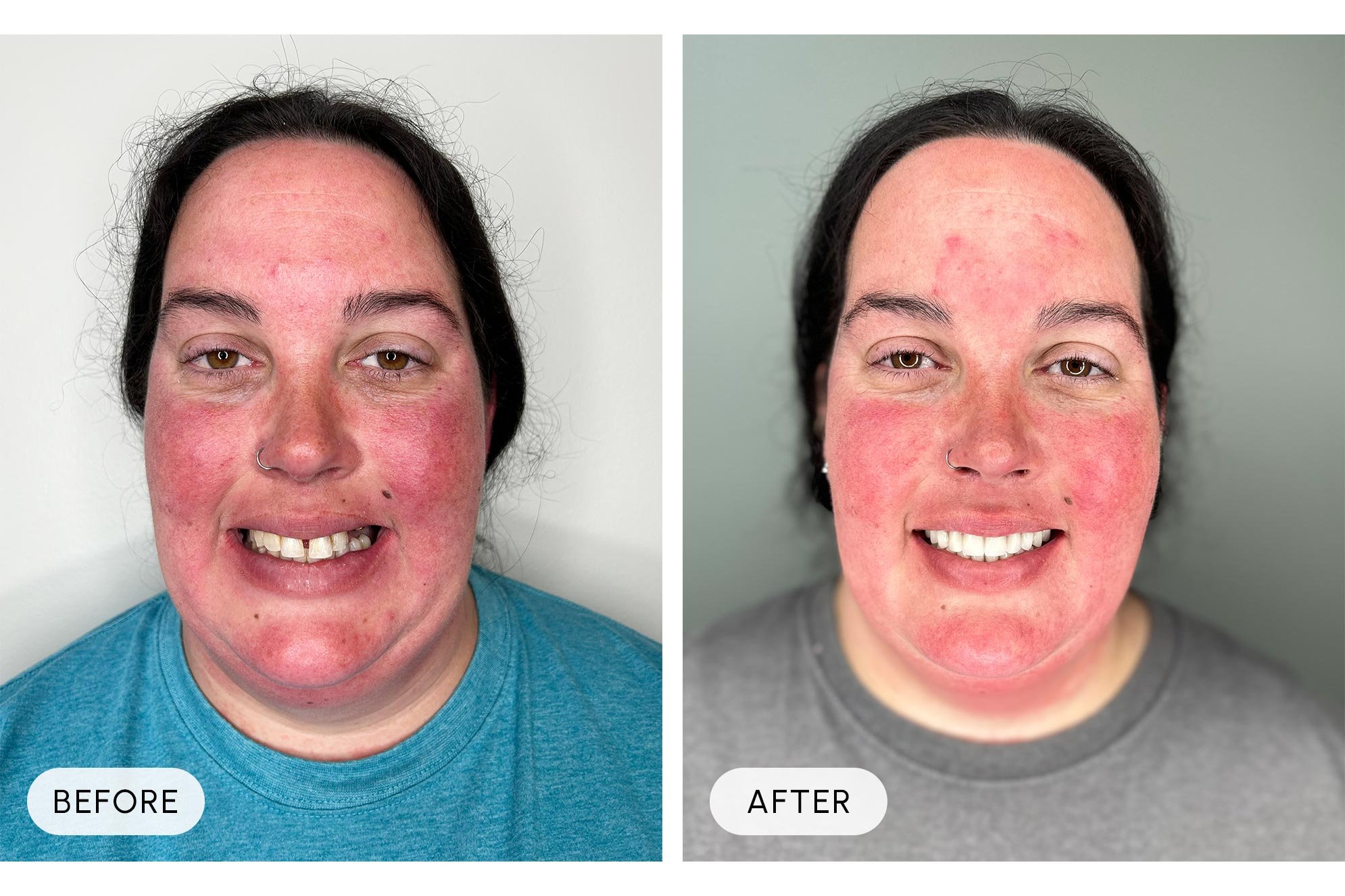 Side-by-side comparison of a woman with red, inflamed skin before and after treatment. The left image shows her with more intense redness and blemishes, while the right image shows reduced redness and clearer skin. Both images have the woman smiling.