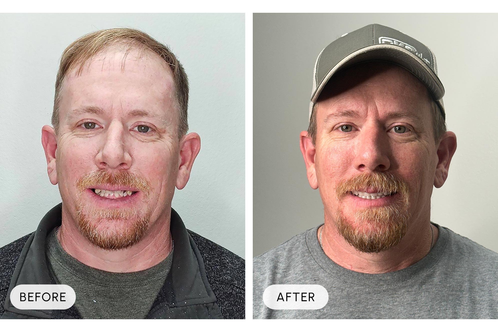 Side-by-side comparison of a man before and after a transformation, showing improved skin and facial appearance, with the left labeled 'Before' and the right labeled 'After'.