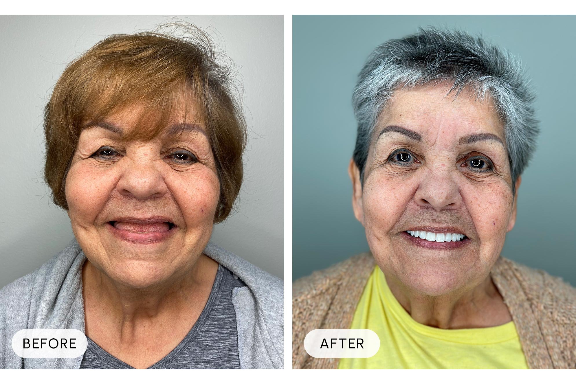 Side-by-side comparison of two older women, the left labeled 'Before' showing a woman with short, light brown hair, smiling with her tongue slightly out, and the right labeled 'After' showing a woman with short gray hair, smiling with teeth visible, 