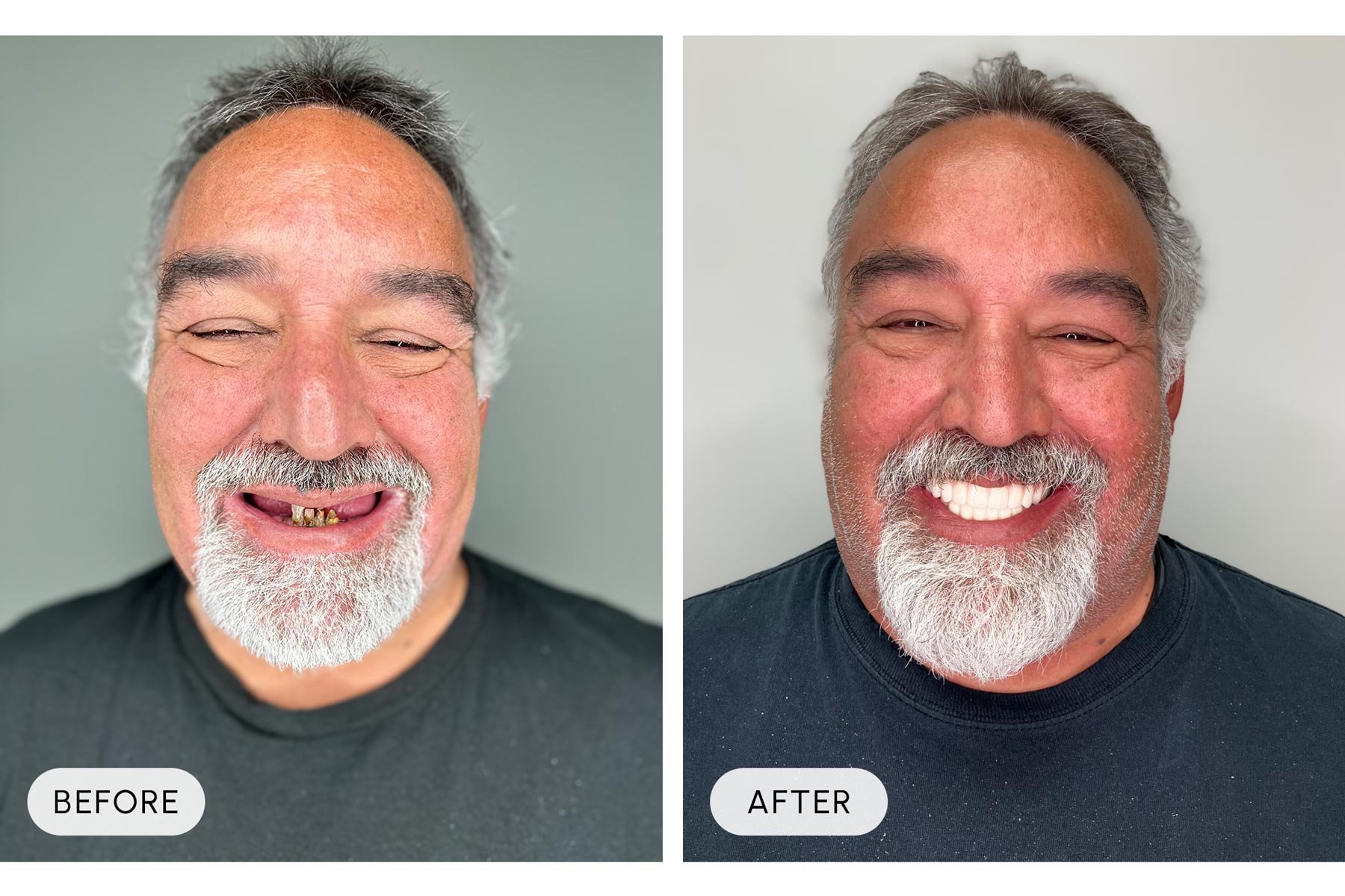 Side-by-side comparison of a middle-aged man with gray hair and beard before and after dental treatment. In the before photo, the man has broken, discolored, and missing teeth, while in the after photo, he has a complete, white smile.