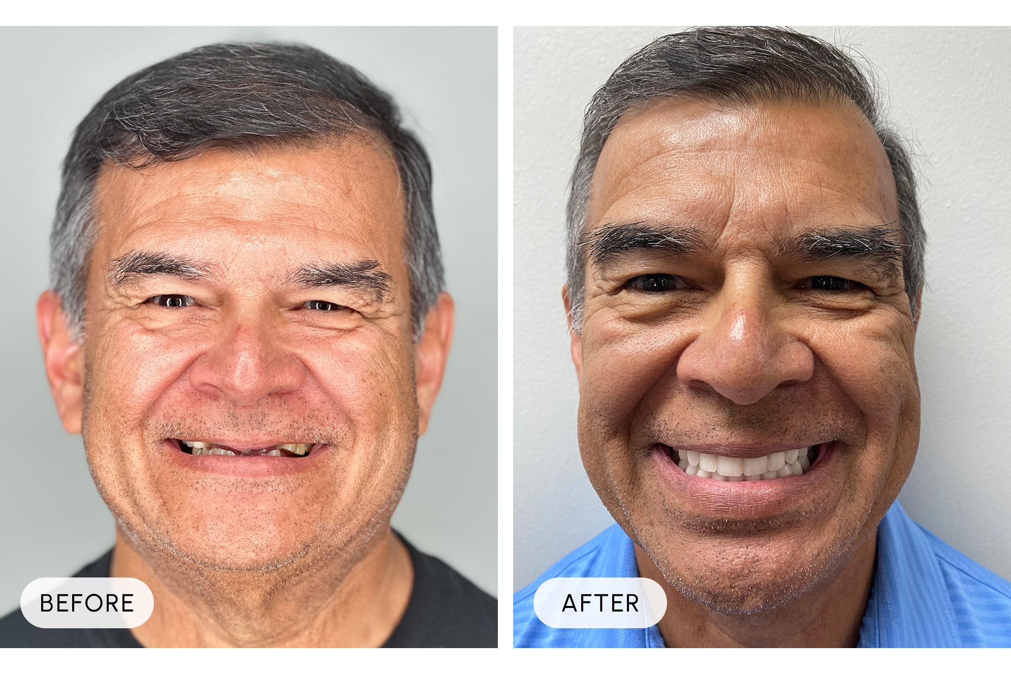 Side-by-side comparison of a man before and after dental work, with the label 'BEFORE' under the left photo and 'AFTER' under the right photo. The man is smiling in both images, showing his teeth, with noticeable improvements in dental appearance.