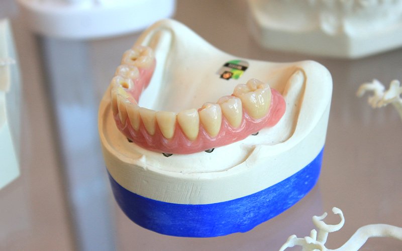 A set of dentures, one dental implant alternative, sitting on a dental model stand.