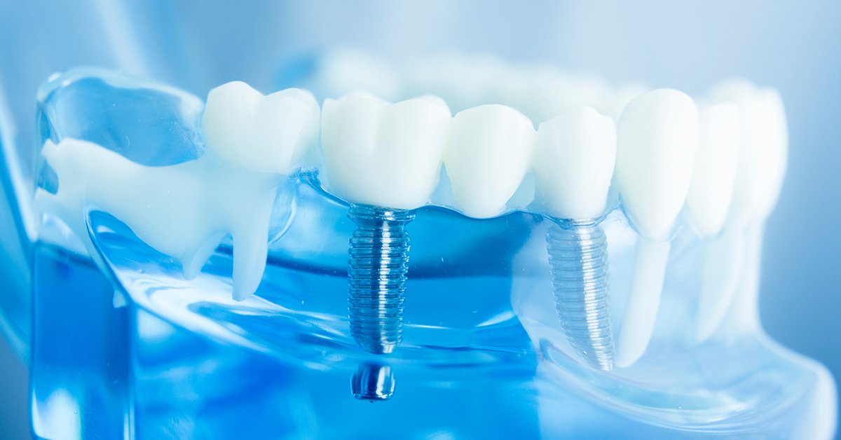 Model of a tooth implant