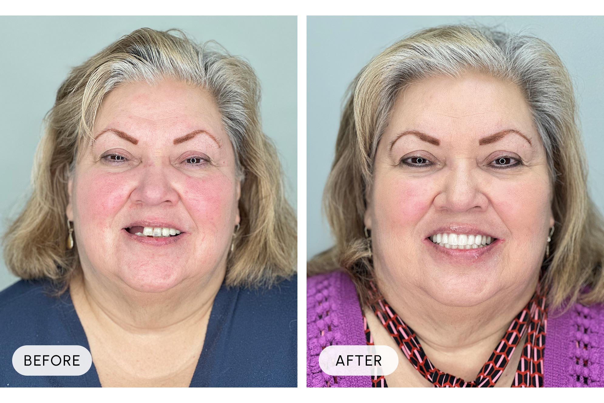 Side-by-side comparison of a woman before and after a facial treatment. The 'before' image shows her with red, uneven skin tone and missing teeth. The 'after' image shows her with smoother skin, a brighter complexion, and a full set of teeth, smiling